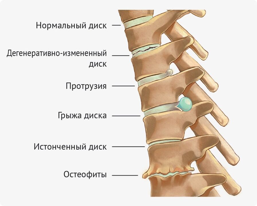 Disc deformities for osteochondrosis lumbar