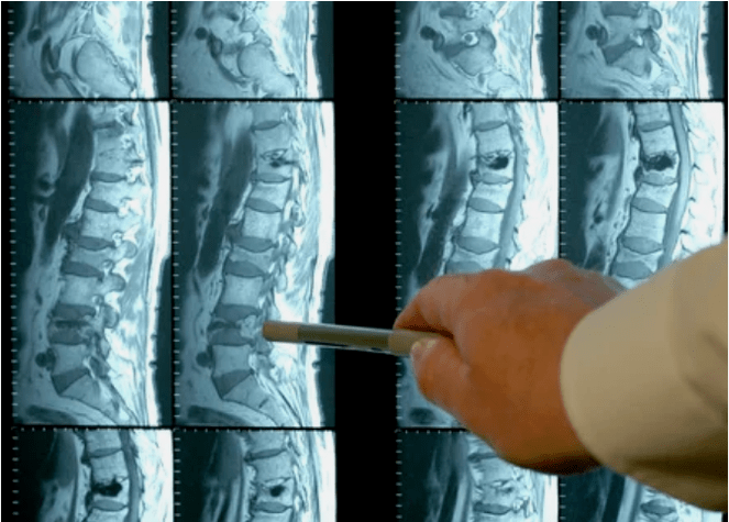 Varieties of osteochondrosis in the spine
