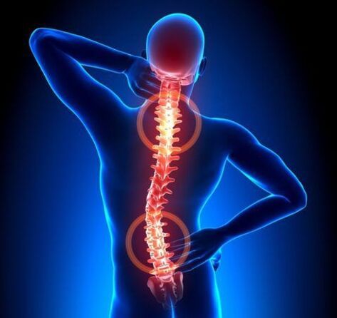 Spine osteochondrosis