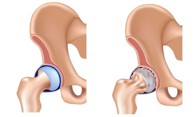 Healthy articulation and arthrosis with arthrosis