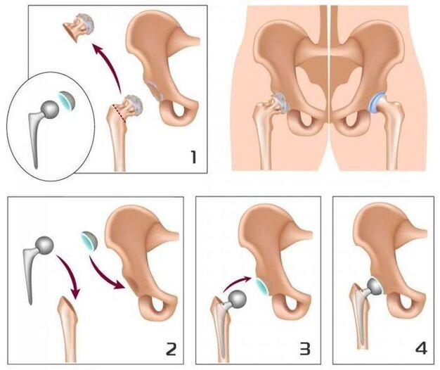 Replacing a painful joint with a prosthesis