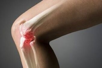 Knee joint arthrosis is a cartilage fabric injury
