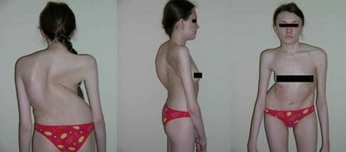 curvature of the spine as a consequence of osteochondrosis