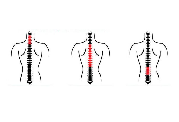 How osteochondrosis manifests itself