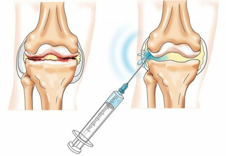 injection into the knee joint with osteoarthritis