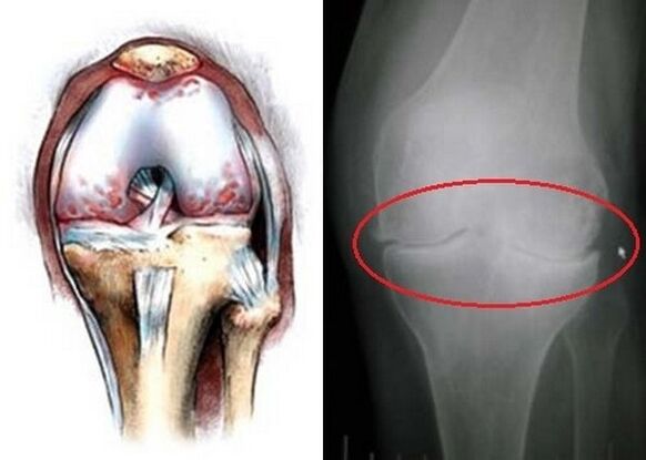 knee joint osteoarthritis