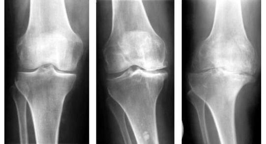 An obligatory diagnostic measure in identifying knee arthrosis is radiography