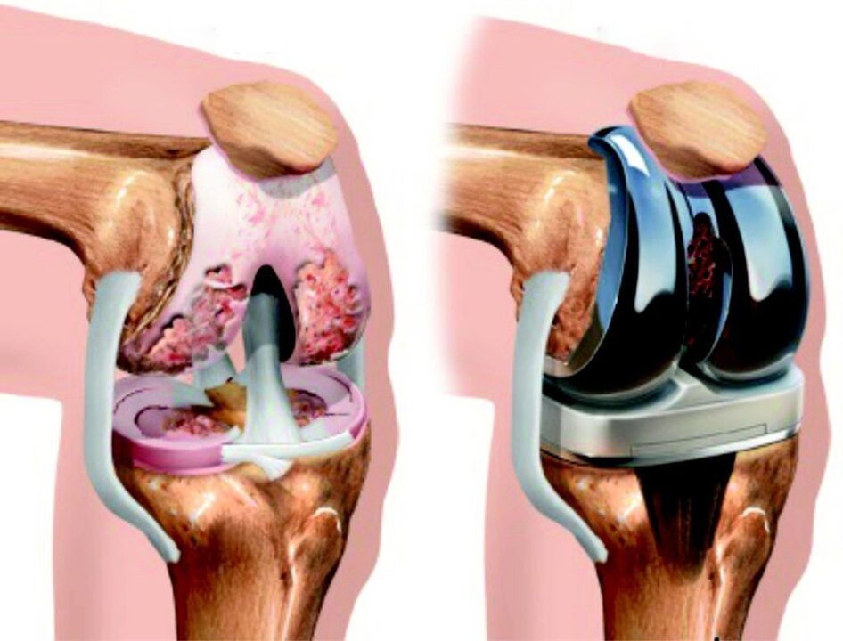 In case of complete damage to the knee joint due to arthrosis, it can be restored using endoprosthesis